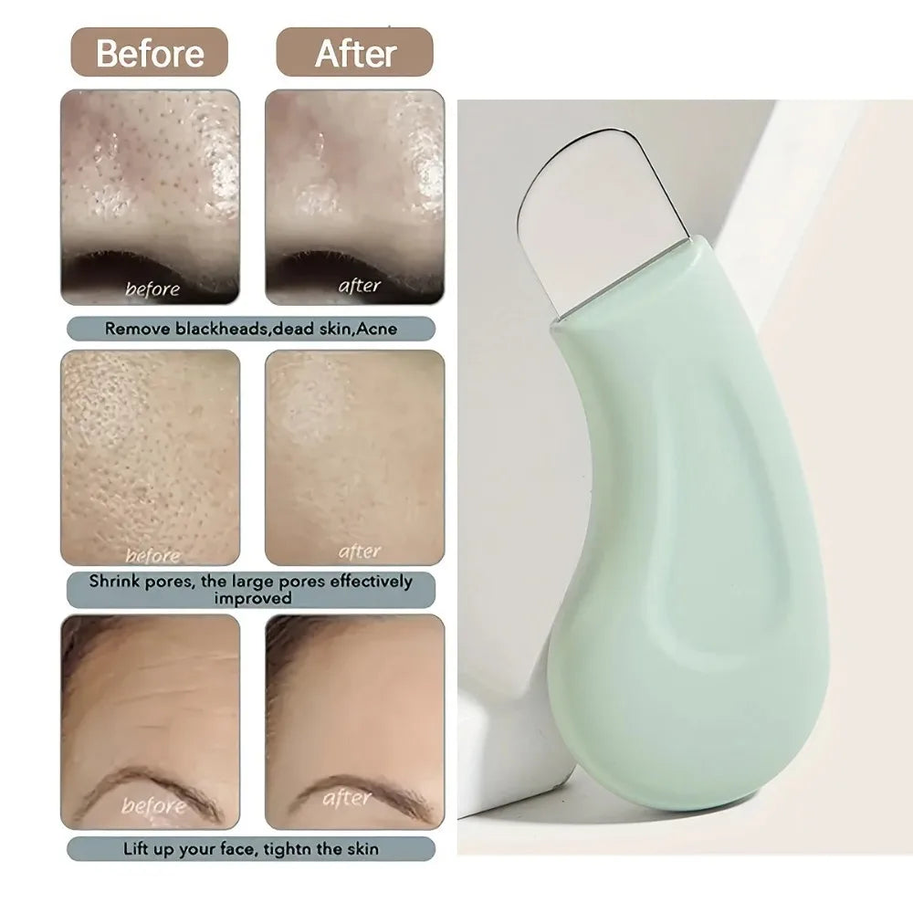 Blackhead and Whitehead Removal Tool